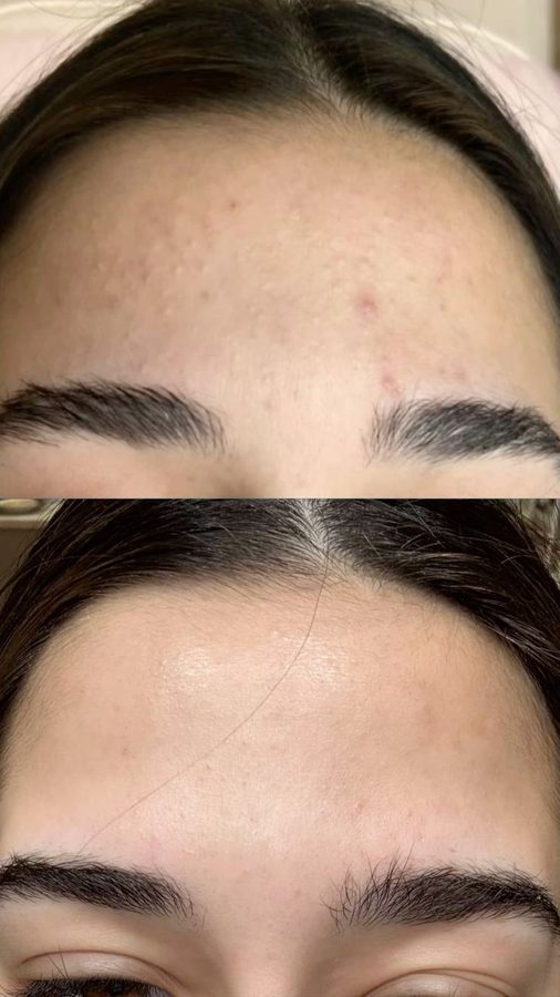 Before and after across the forehead