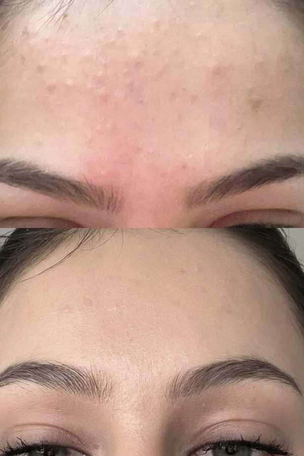 Before and after across the forehead