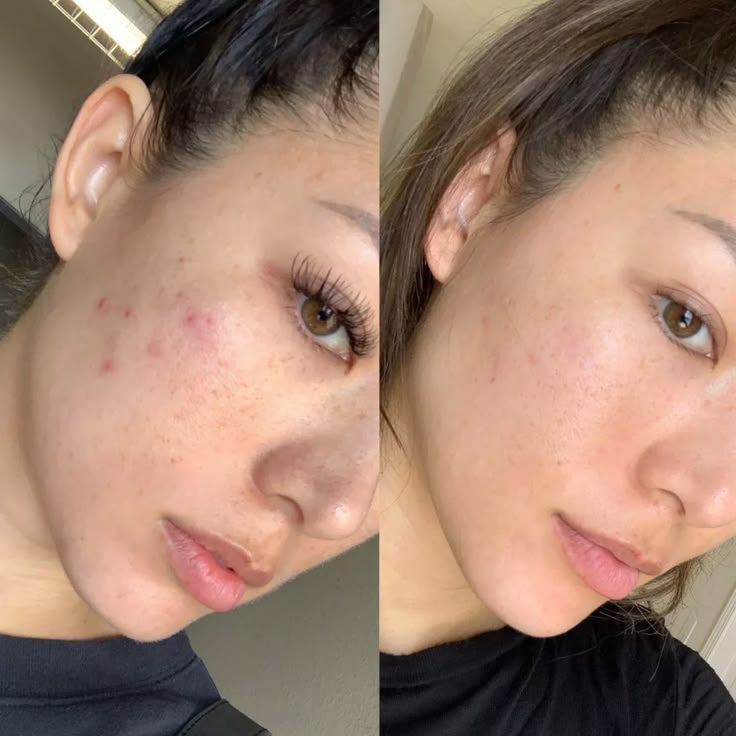 Before and after across the cheeks
