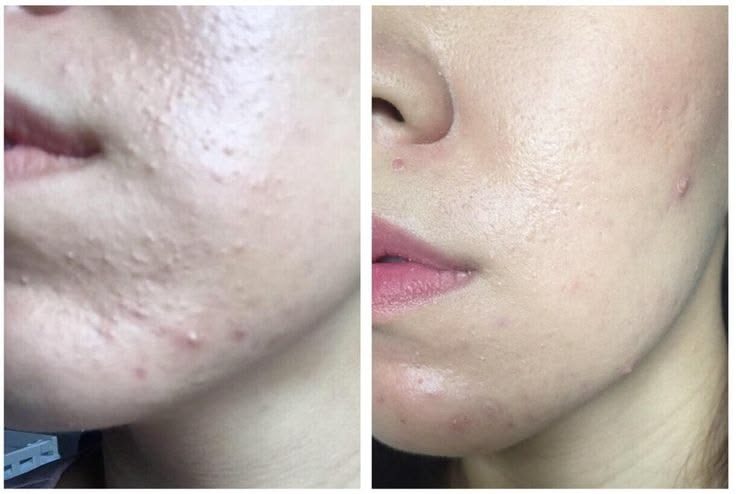 Before and after around the chin and mouth