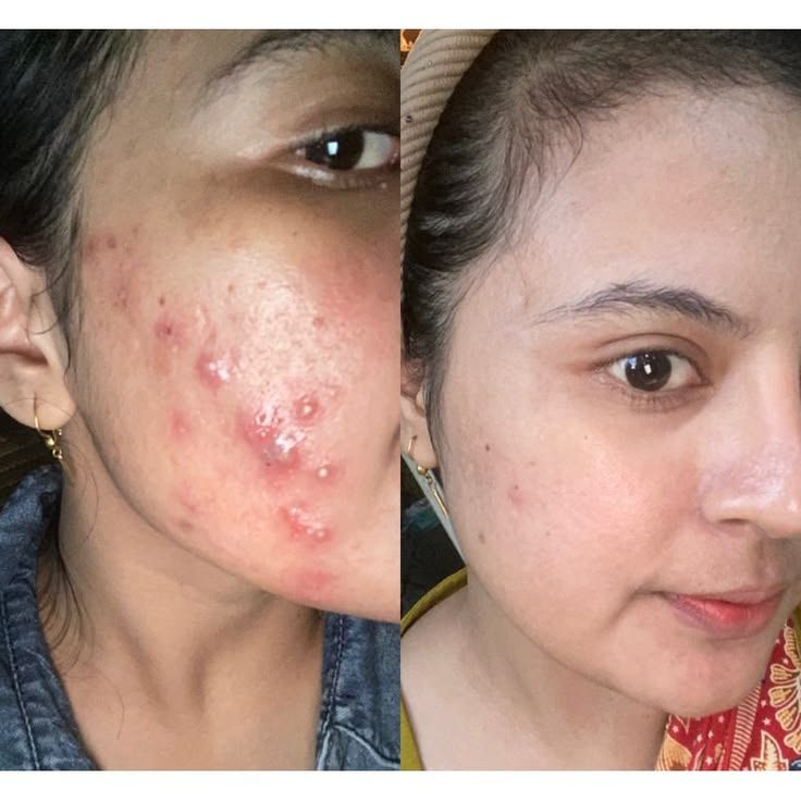 Before and after on inflamed cheek breakouts