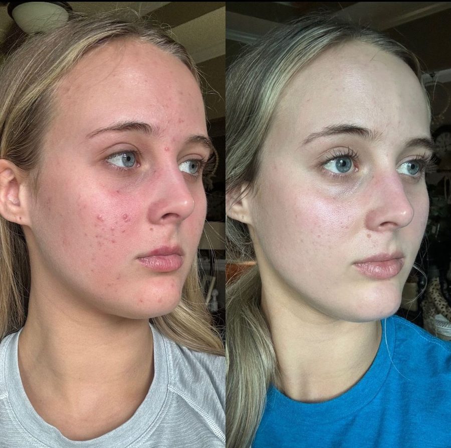 Before and after on sensitive, reactive skin
