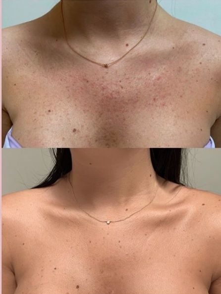 Before and after across the chest