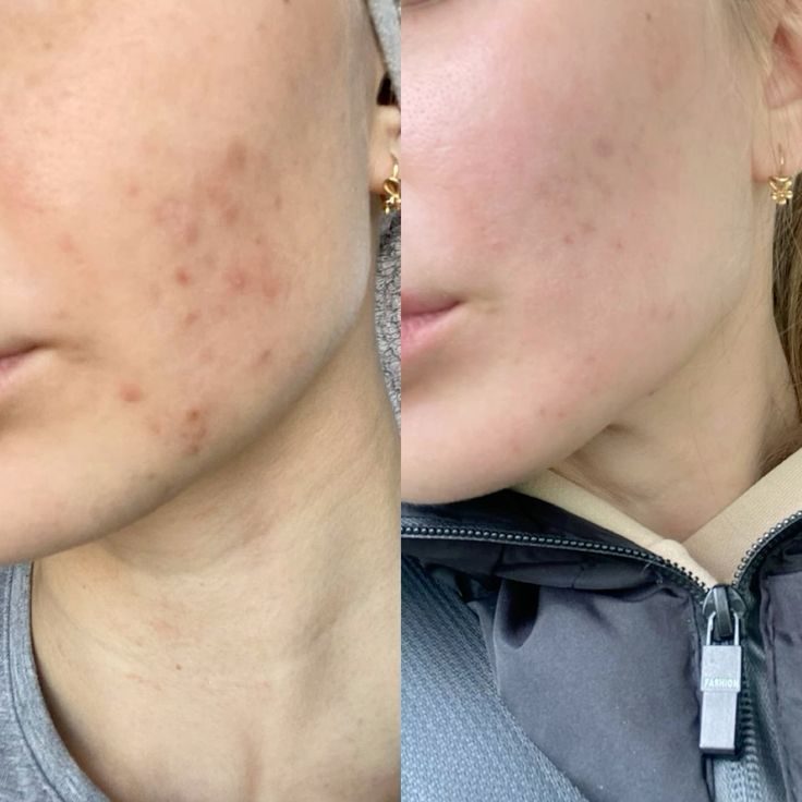 Before and after along the jaw and chin