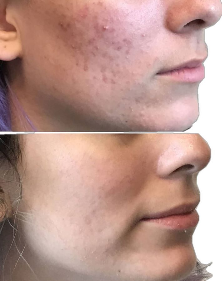 Before and after showing smoother texture