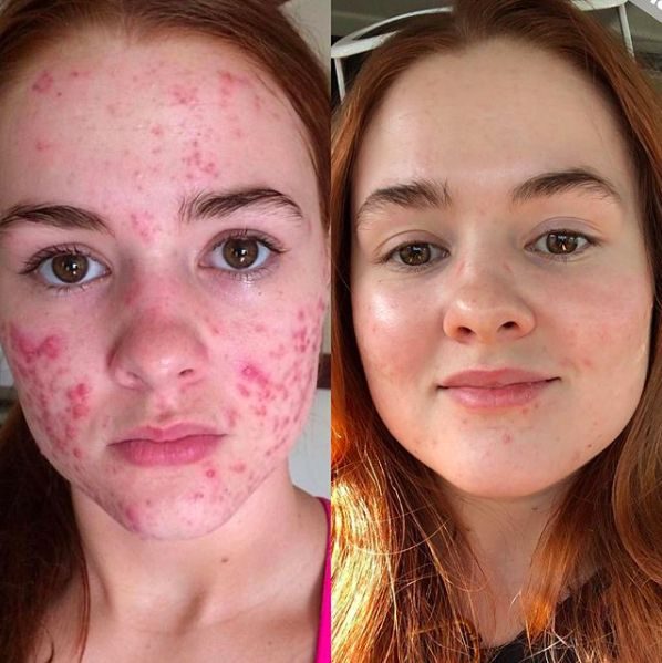 Hannah L. before and after