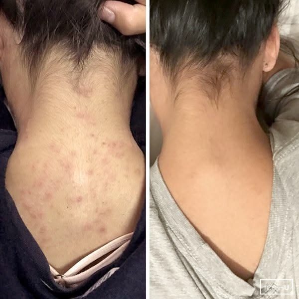 Before and after along the neck and hairline