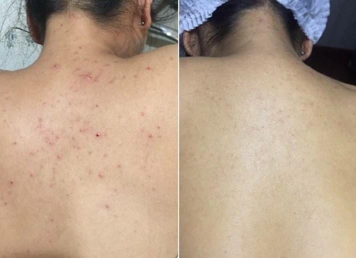 Before and after across the shoulders and back