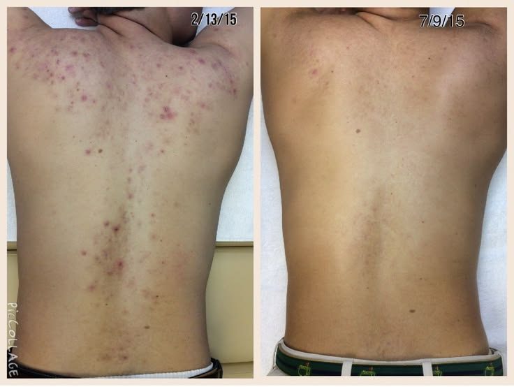 Before and after across the upper back
