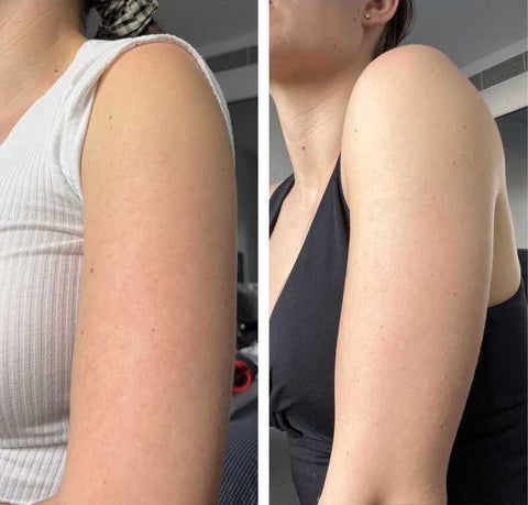 Before and after across the shoulder and upper arm