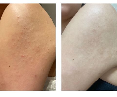 Before and after on the upper arm