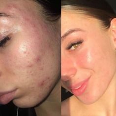 Before and after across the cheek and jaw